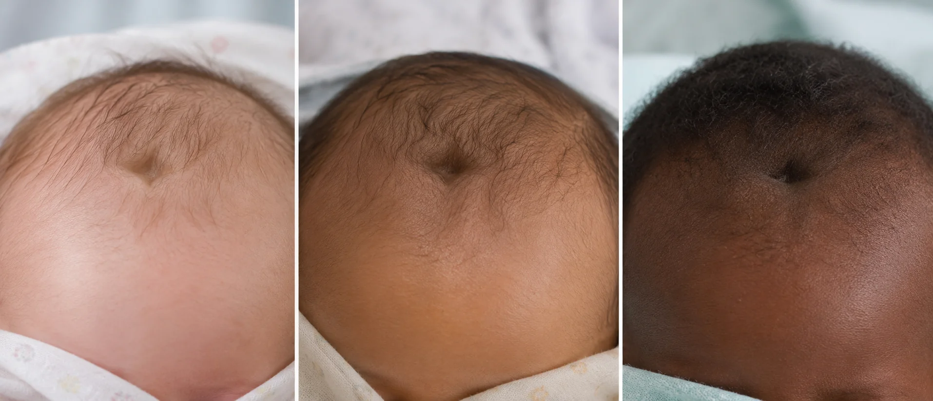 A baby with signs of dehydration — dry lips and a slightly sunken soft spot on the head