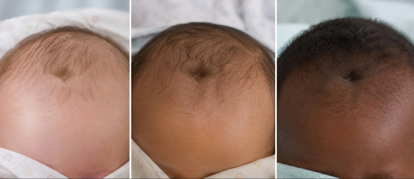 The top of a baby's head showing a sunken fontanelle